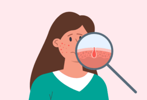 Medical illustration showing a magnified cross-section of a woman’s skin layers.