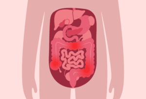 Anatomy of the gastrointestinal system showing areas of inflammation likely due to Crohn’s disease.