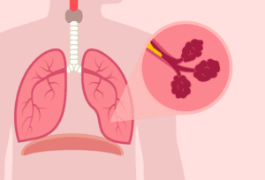 Anatomical illustration showing lung changes and symptoms associated with COPD.