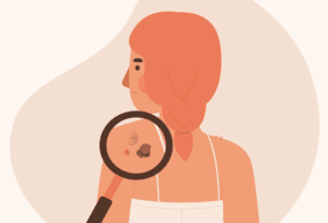 Woman unaware of a skin tag on her skin being examined under a magnifying glass.