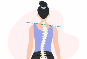 Woman with spinal misalignment that may indicate scoliosis rather than poor posture.