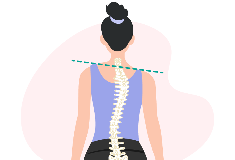 Woman with spinal misalignment that may indicate scoliosis rather than poor posture.
