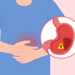 Stomach infection caused by H. pylori that may increase the risk of gastric cancer if left untreated.