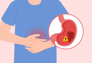 Stomach infection caused by H. pylori that may increase the risk of gastric cancer if left untreated.