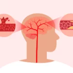 Illustration of stroke symptoms in the human brain.