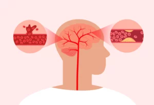 Illustration of stroke symptoms in the human brain.