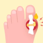 Toe affected by a gout flare with redness and swelling.