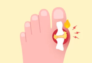 Toe affected by a gout flare with redness and swelling.