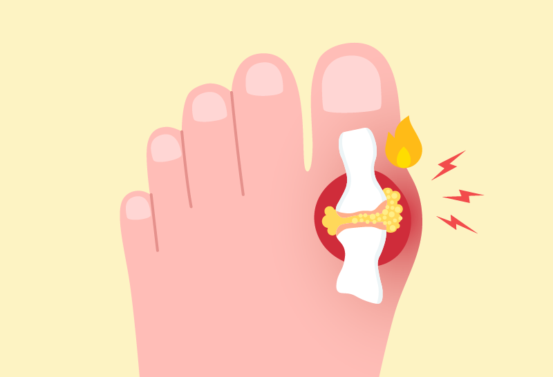 Toe affected by a gout flare with redness and swelling.