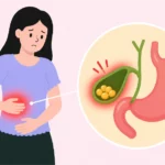 Women experiencing pain due to gallstones